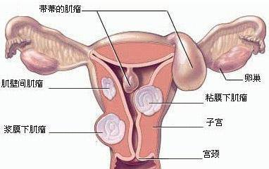 子宫肌瘤引起心脏不适子宫肌瘤引起心脏不适，症状、原因及应对策略